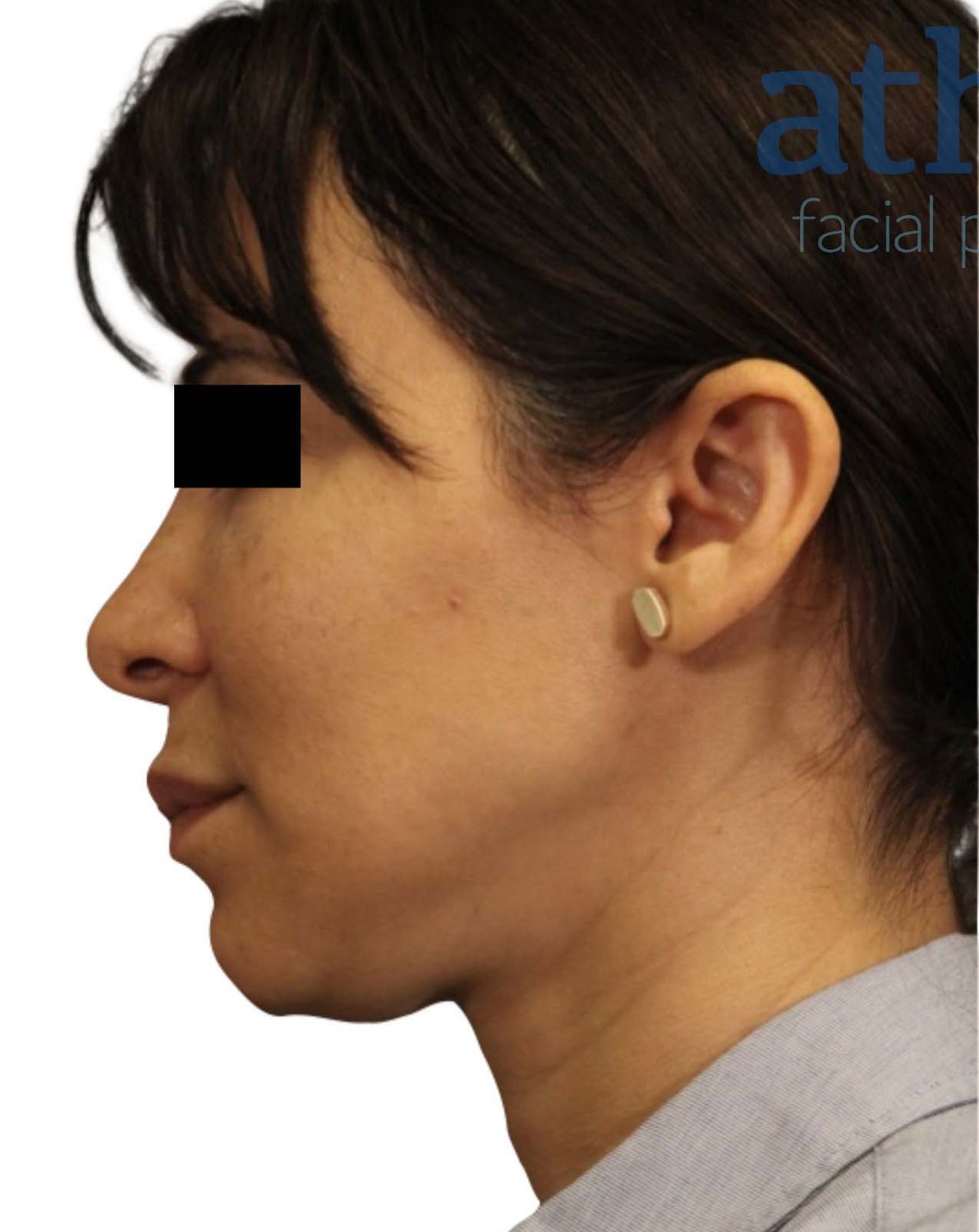 Facelift Before & After