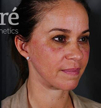 Facelift Before & After