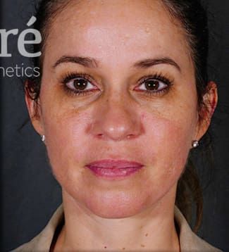 Facelift Before & After