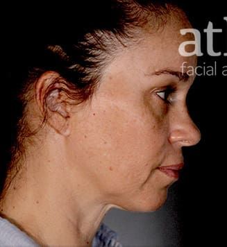 Facelift Before & After