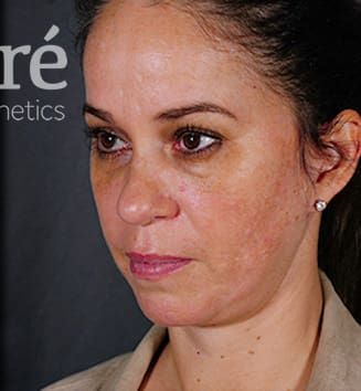 Facelift Before & After