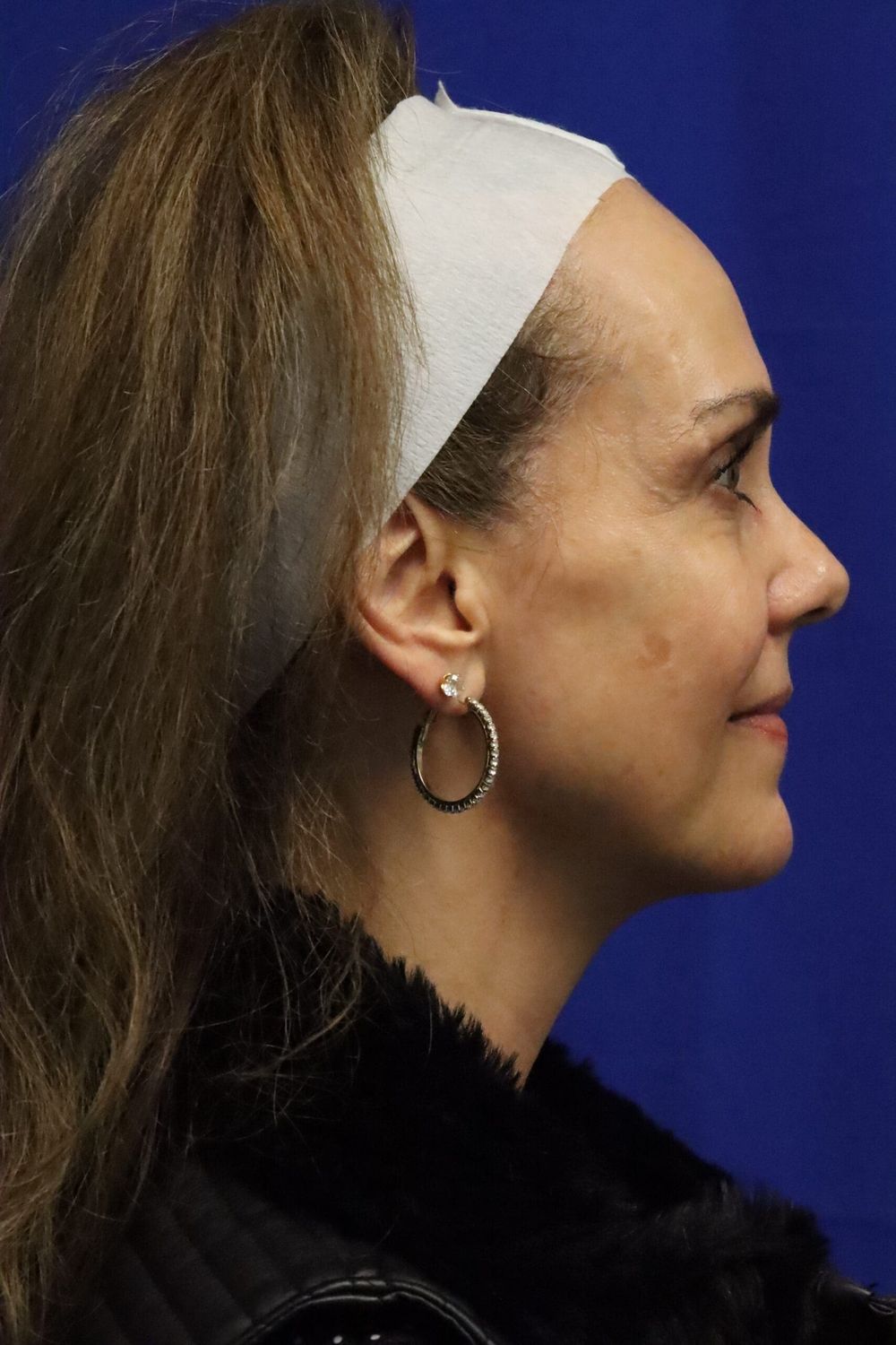 Facelift Before & After