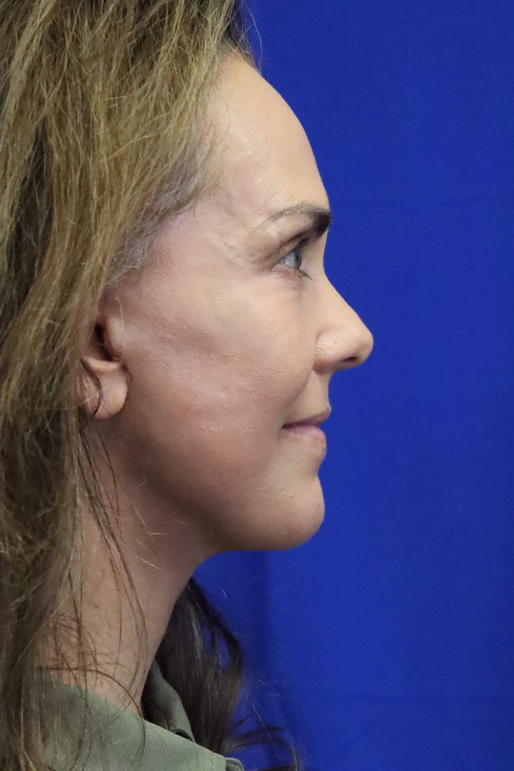 Facelift Before & After