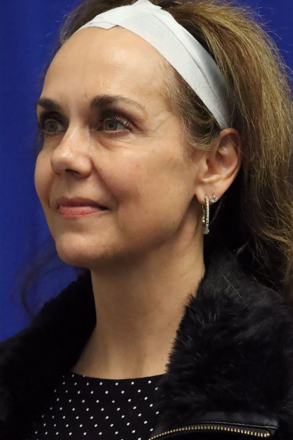 Facelift Before & After