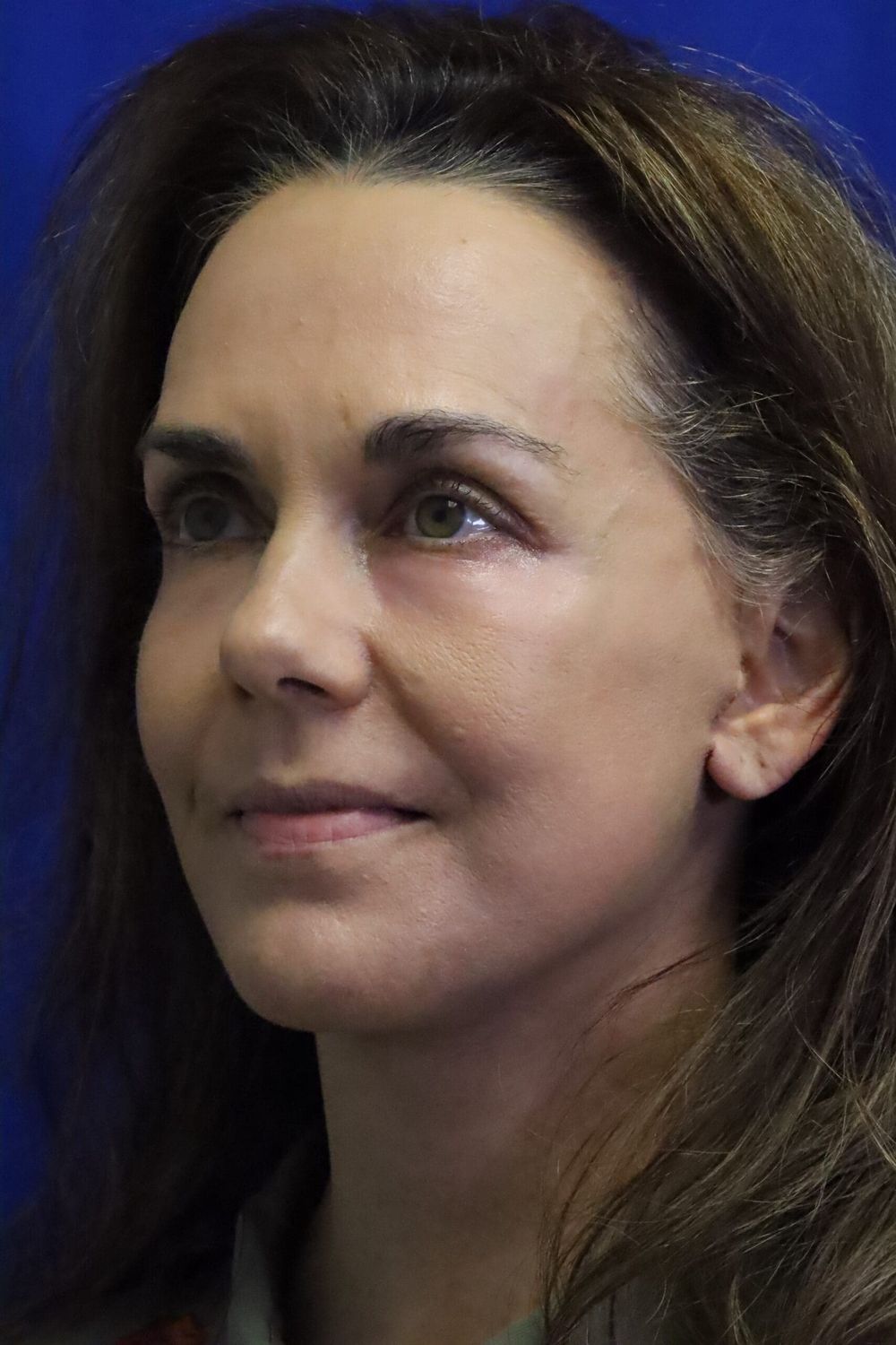 Facelift Before & After