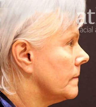 Facelift Before & After