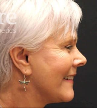 Facelift Before & After