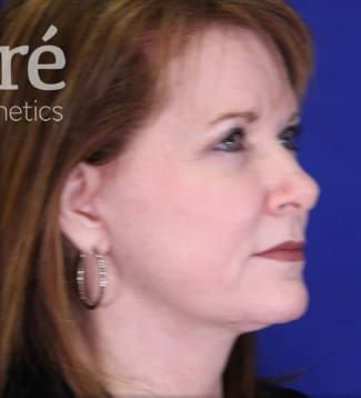 Facelift Before & After