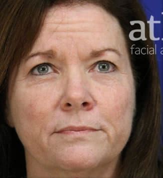 Facelift Before & After
