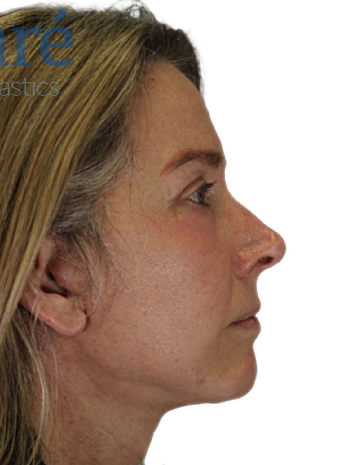 Facelift Before & After