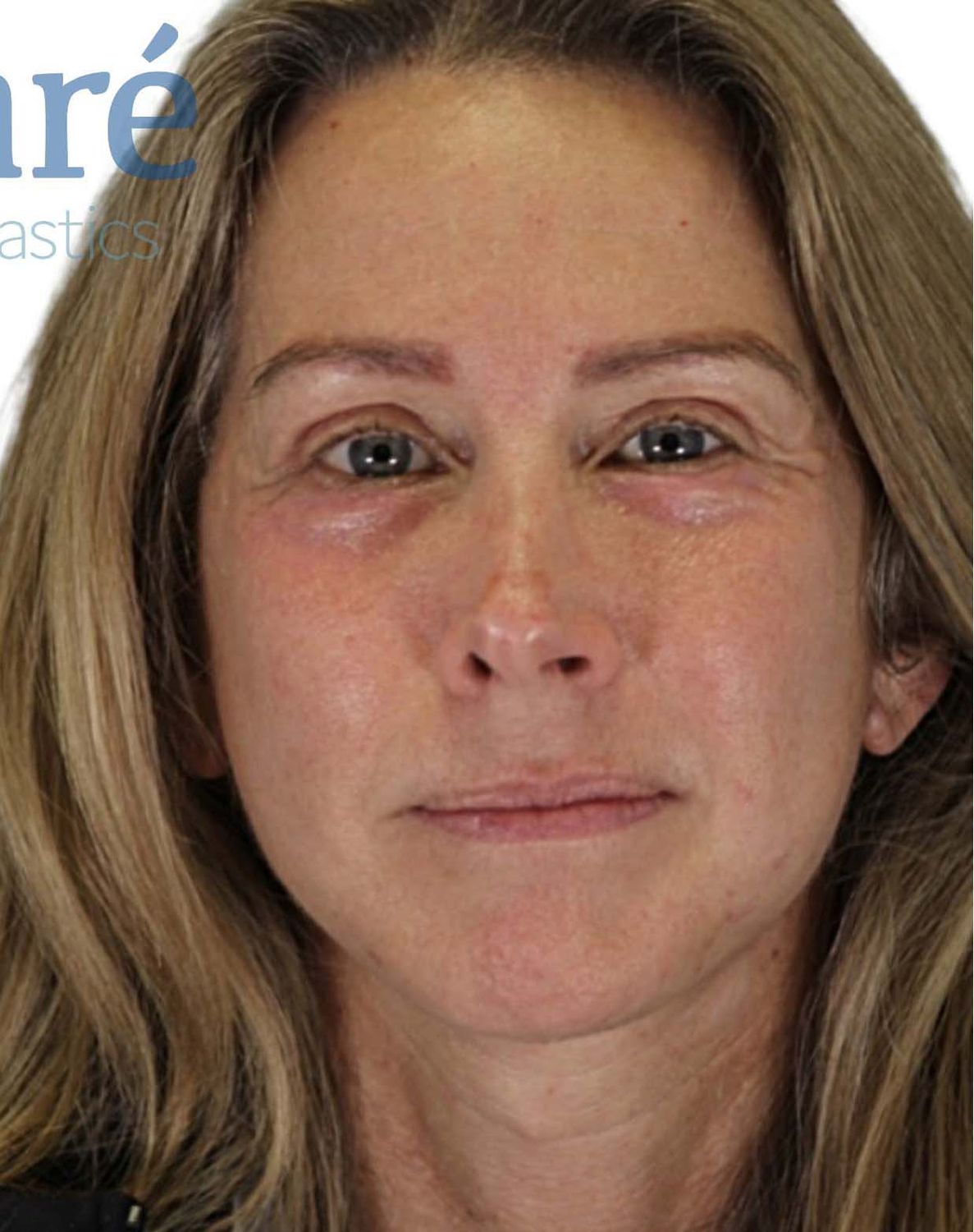 Facelift Before & After