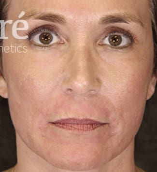 Facelift Before & After