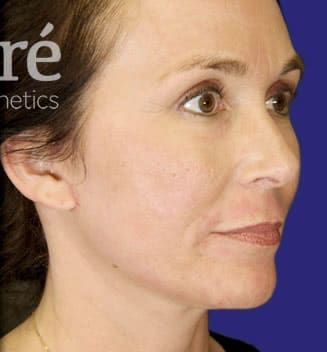 Facelift Before & After