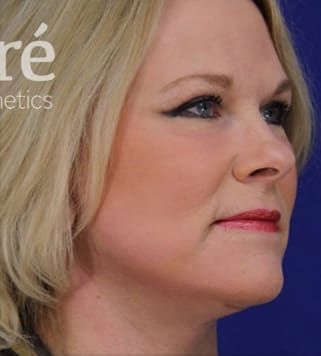 Facelift Before & After