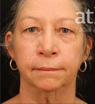 Facelift Before & After