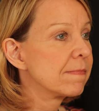 Facelift Before & After