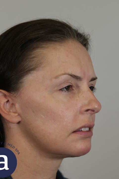 Facelift Before & After
