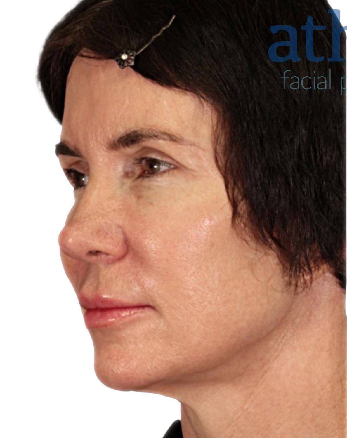 Facelift Before & After