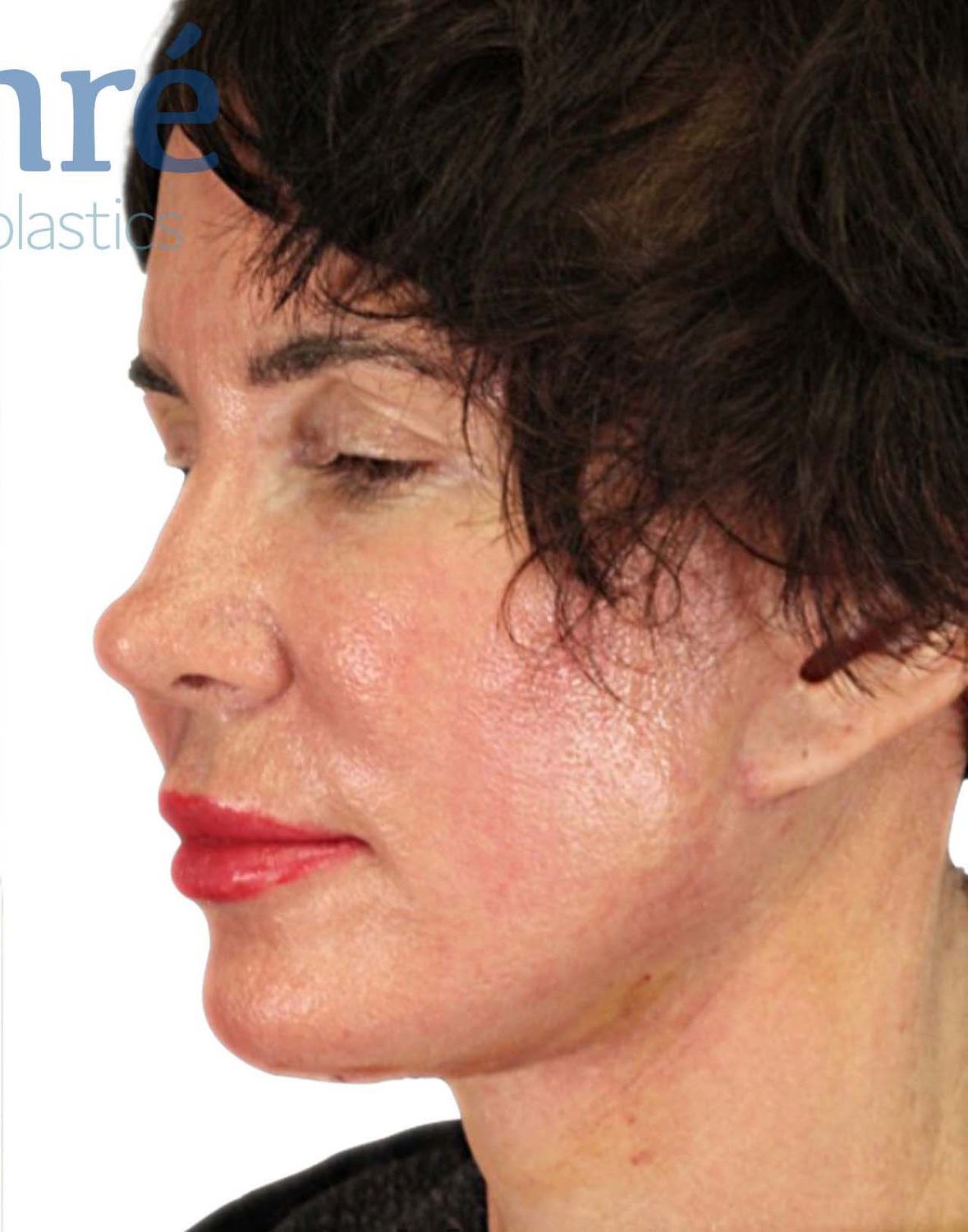 Facelift Before & After