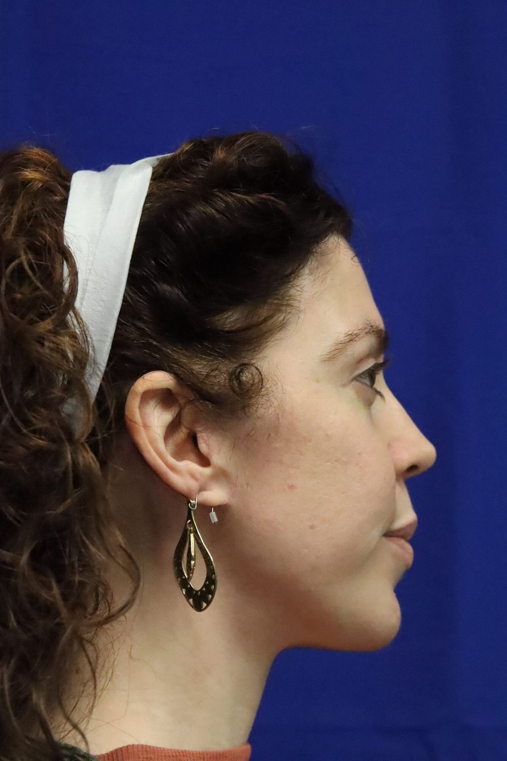 Facelift Before & After