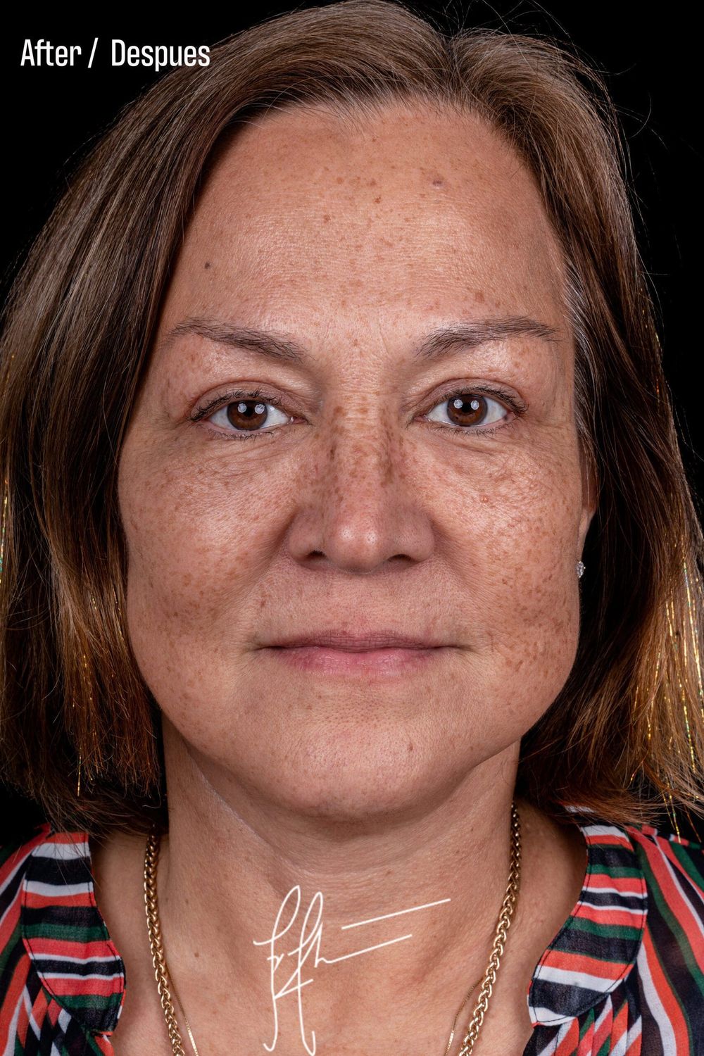 Facelift Before & After