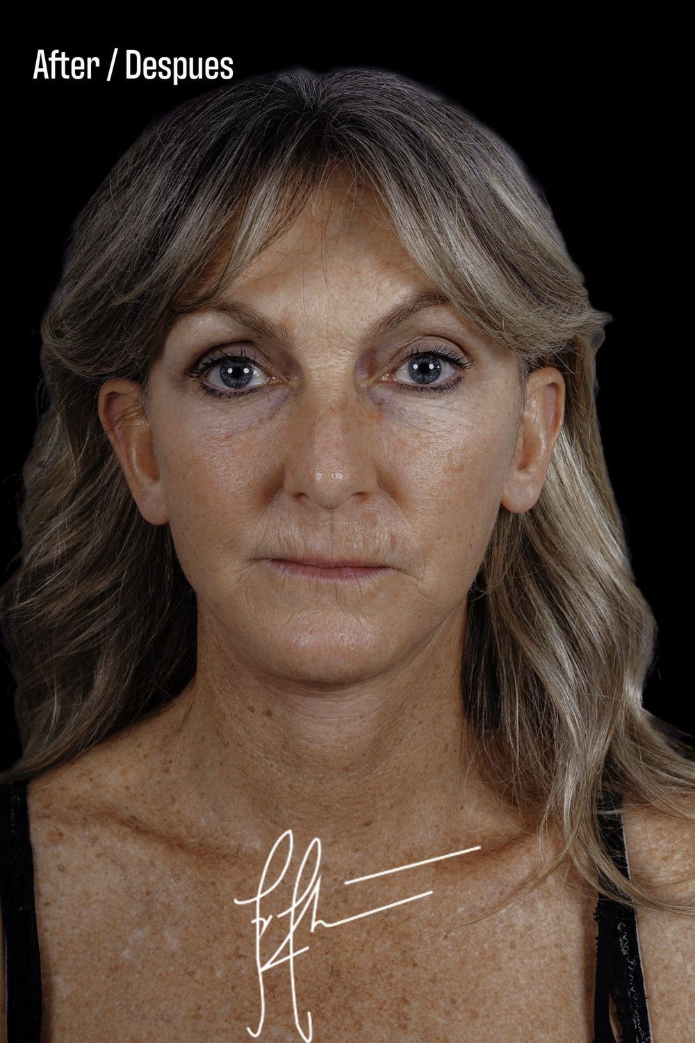 Facelift Before & After