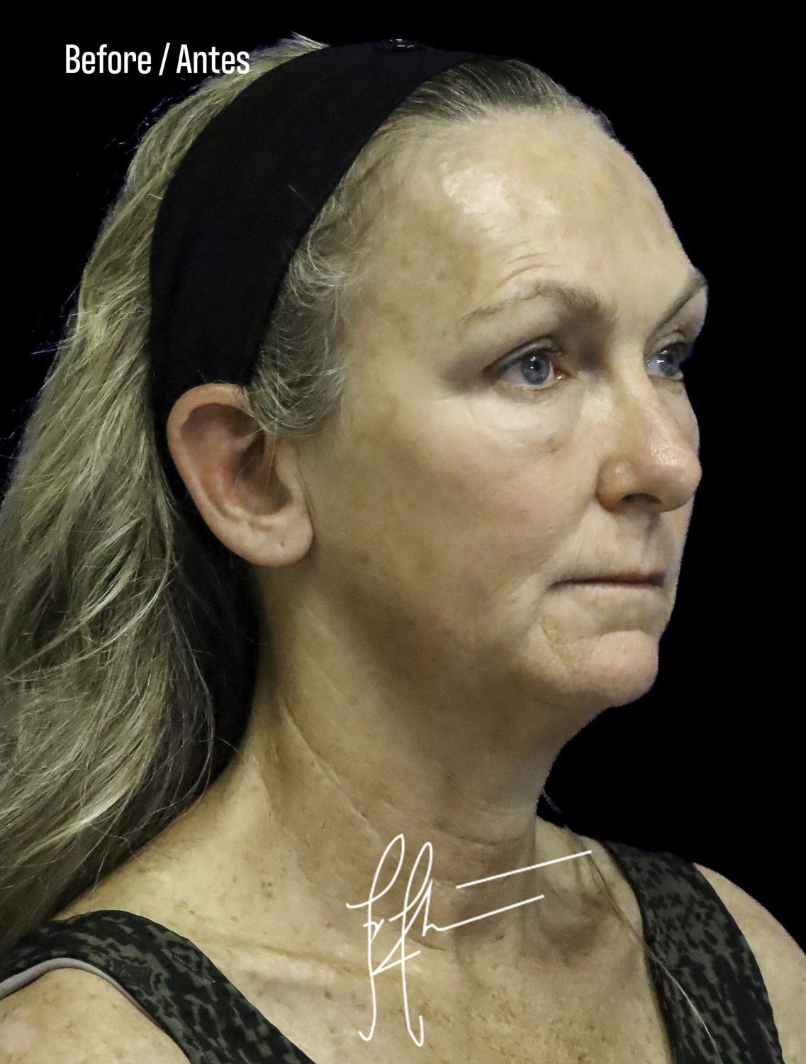 Facelift Before & After