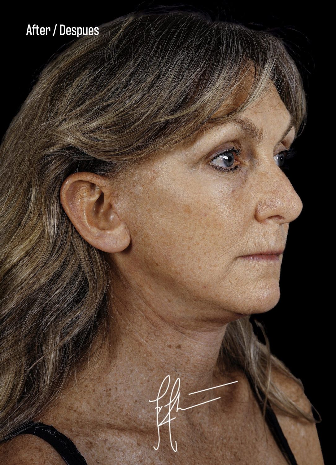 Facelift Before & After