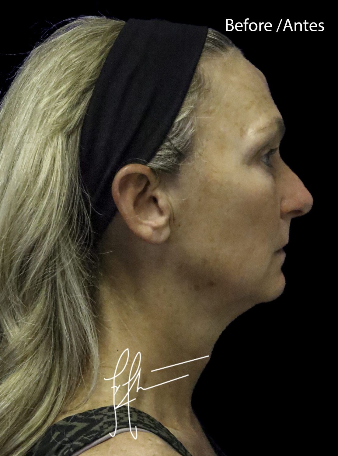 Facelift Before & After