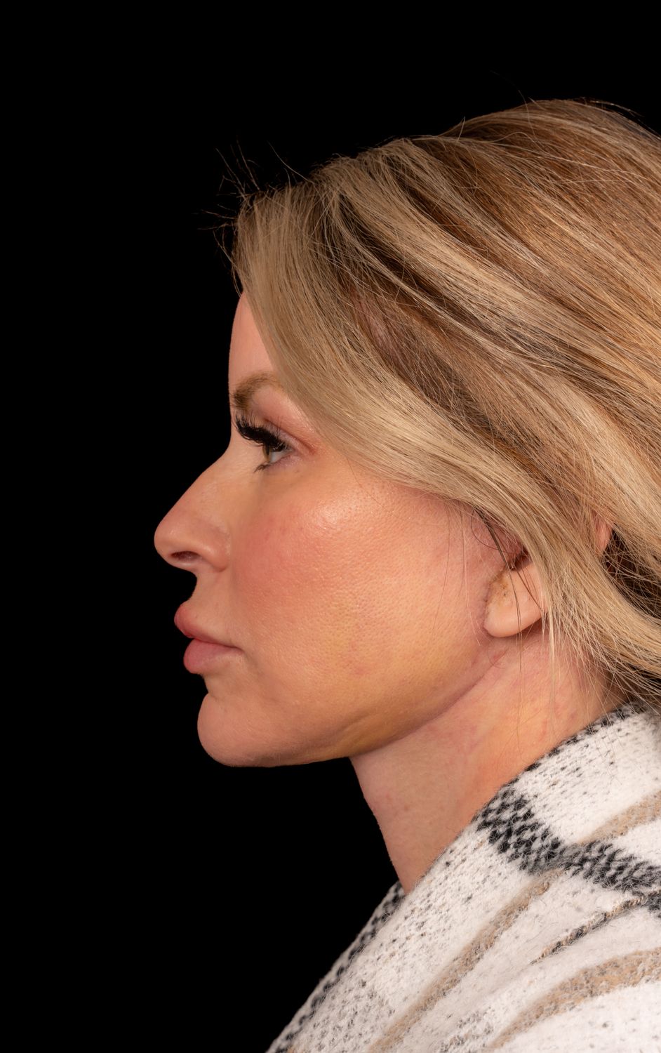 Facelift Before & After