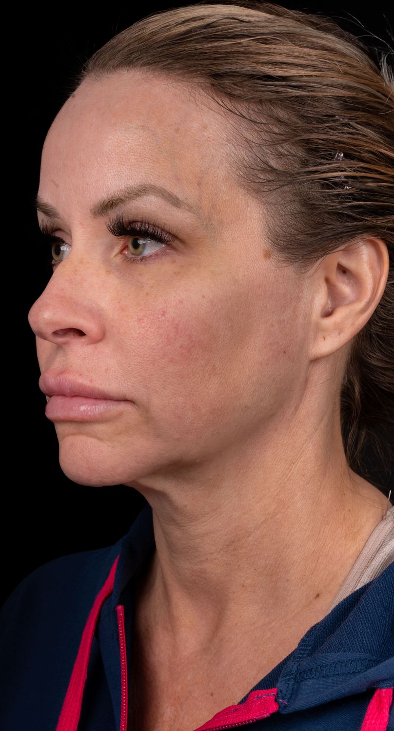 Facelift Before & After