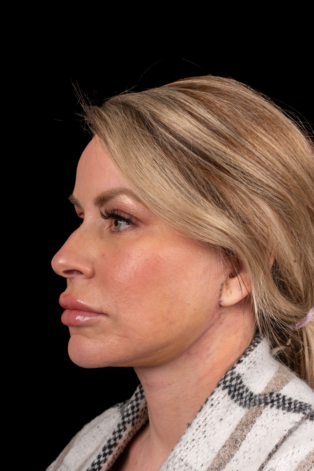 Facelift Before & After