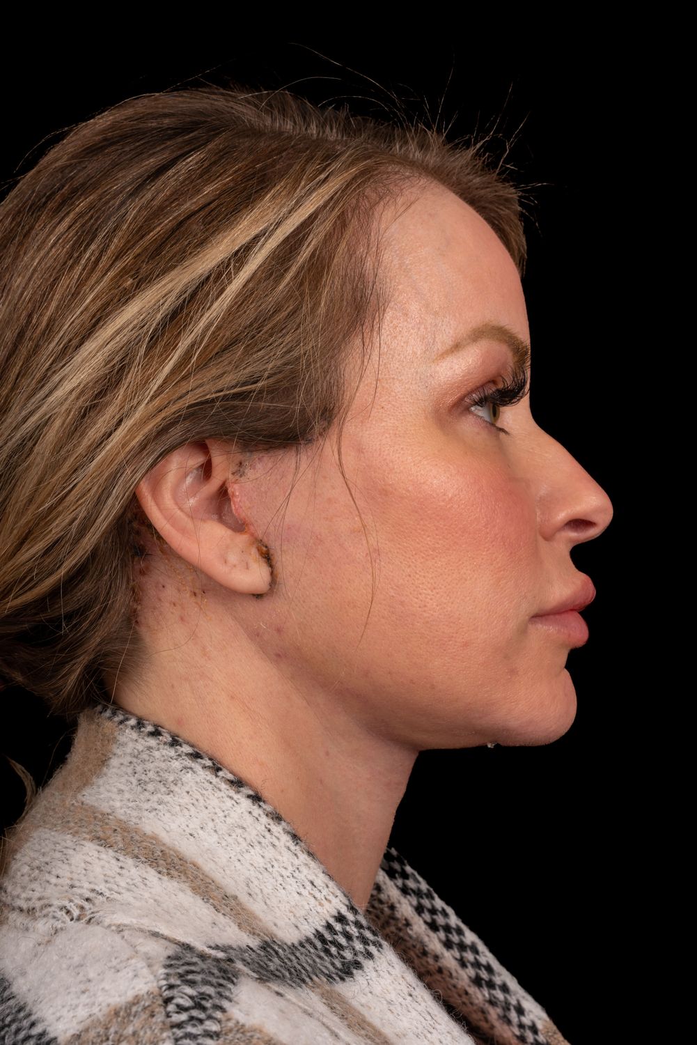 Facelift Before & After