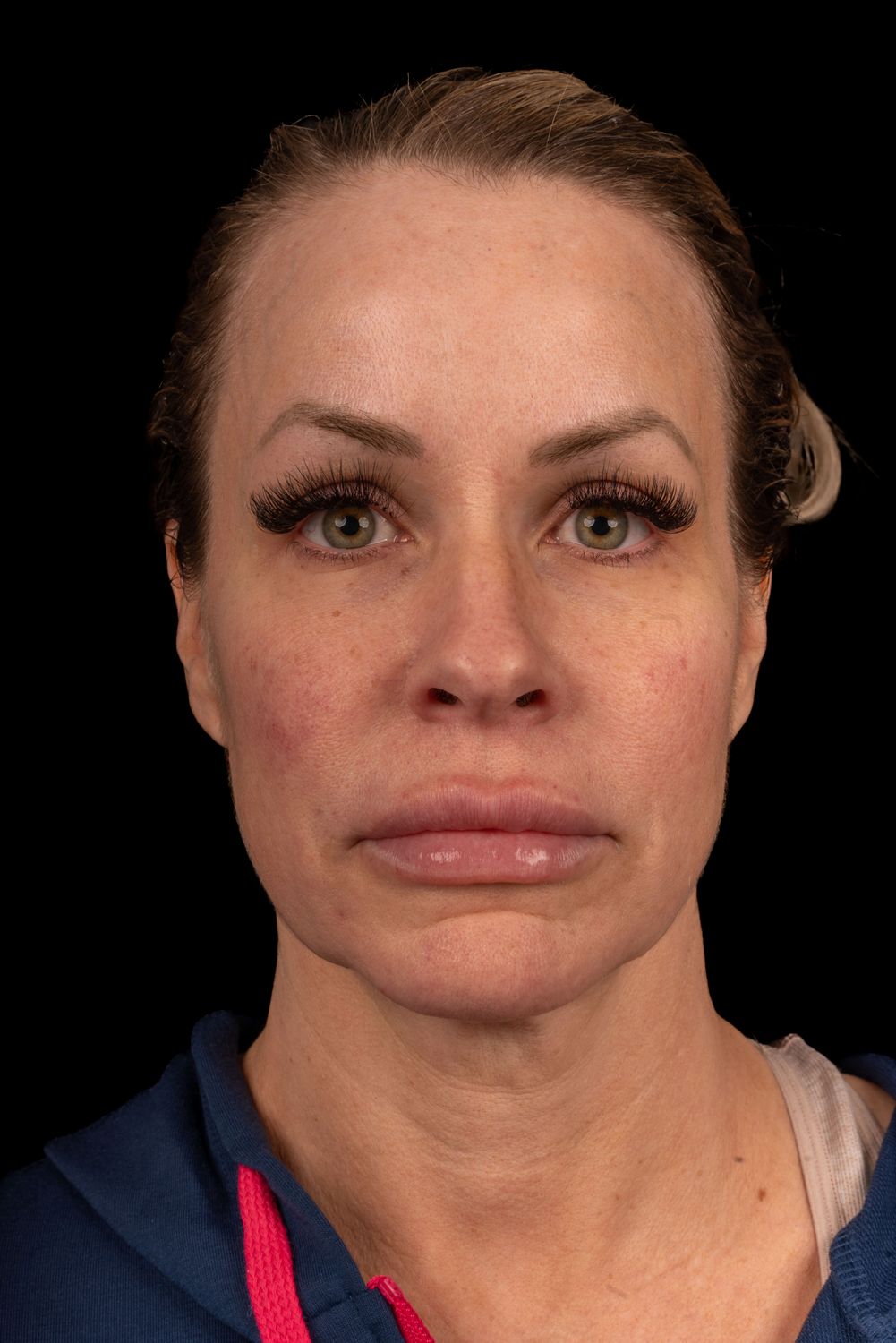 Facelift Before & After