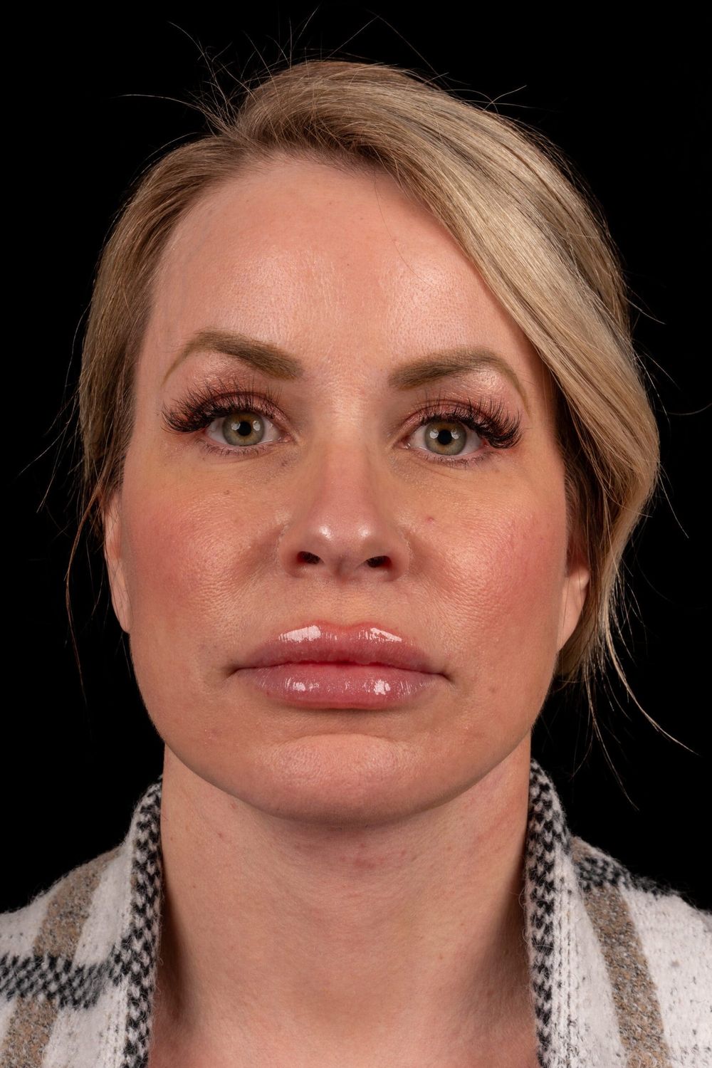 Facelift Before & After