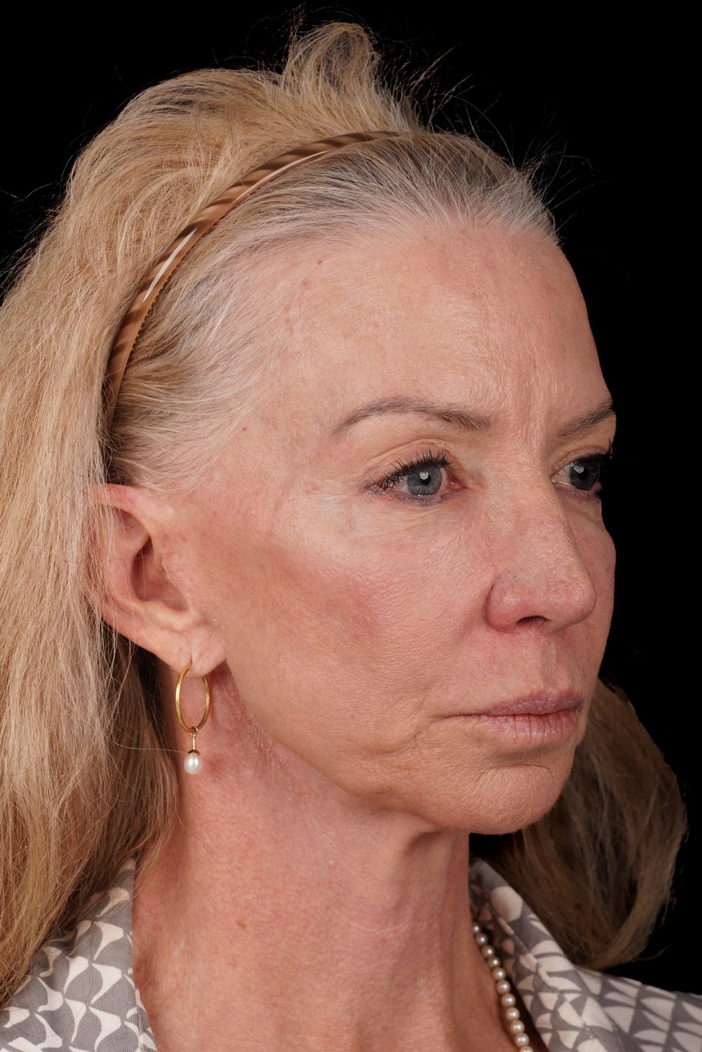 Facelift Before & After