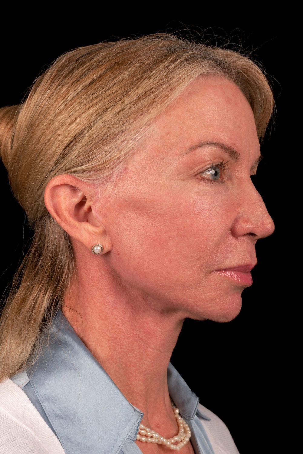 Facelift Before & After