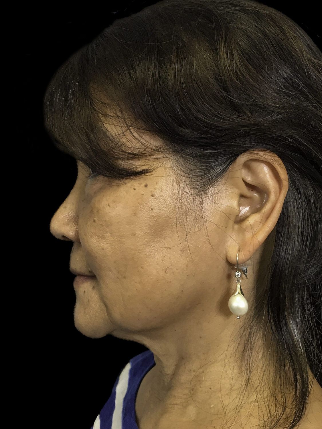 Facelift Before & After