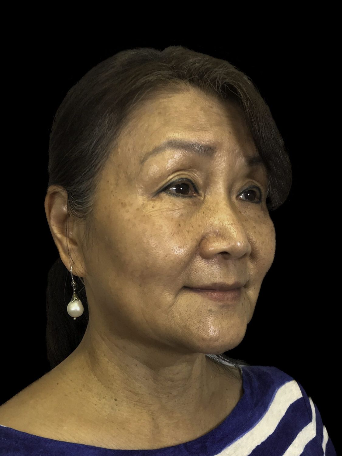 Facelift Before & After