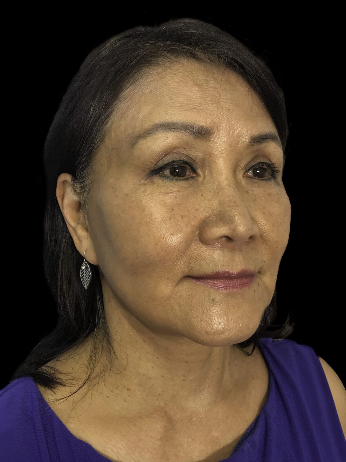 Facelift Before & After