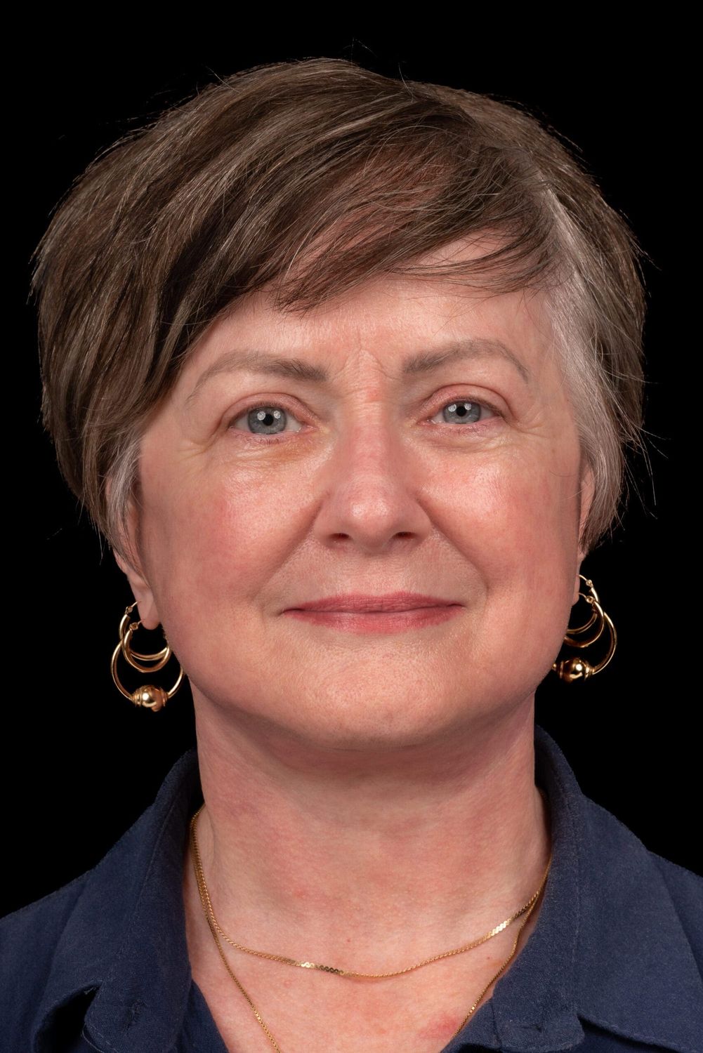 Facelift Before & After