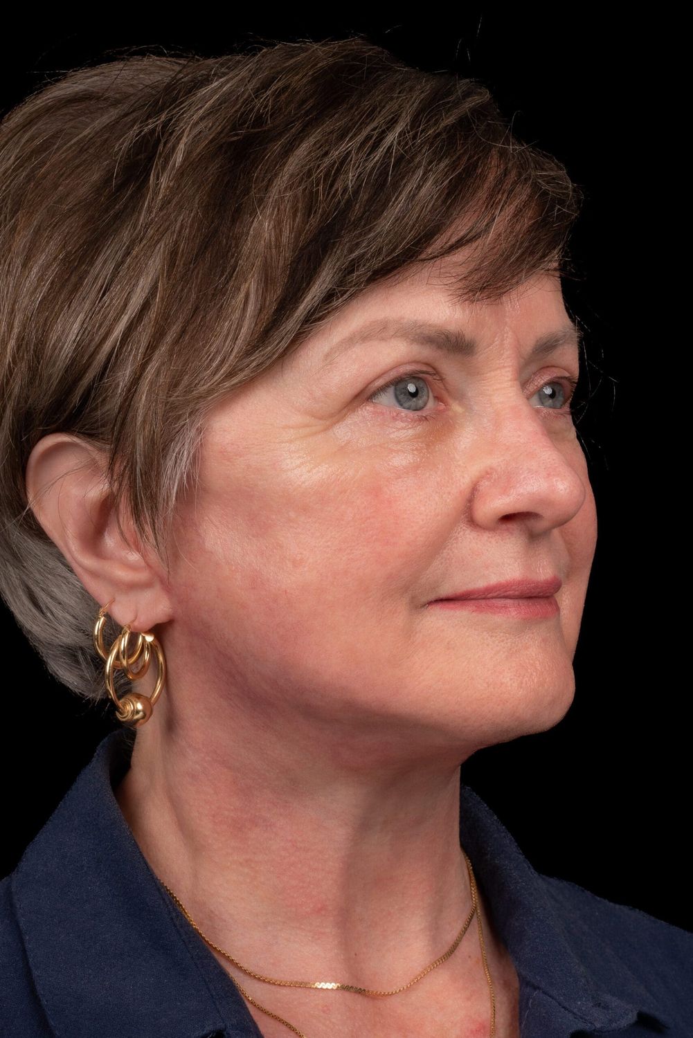 Facelift Before & After