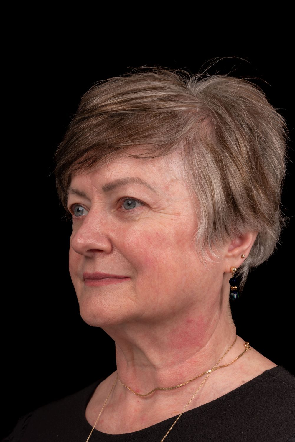 Facelift Before & After