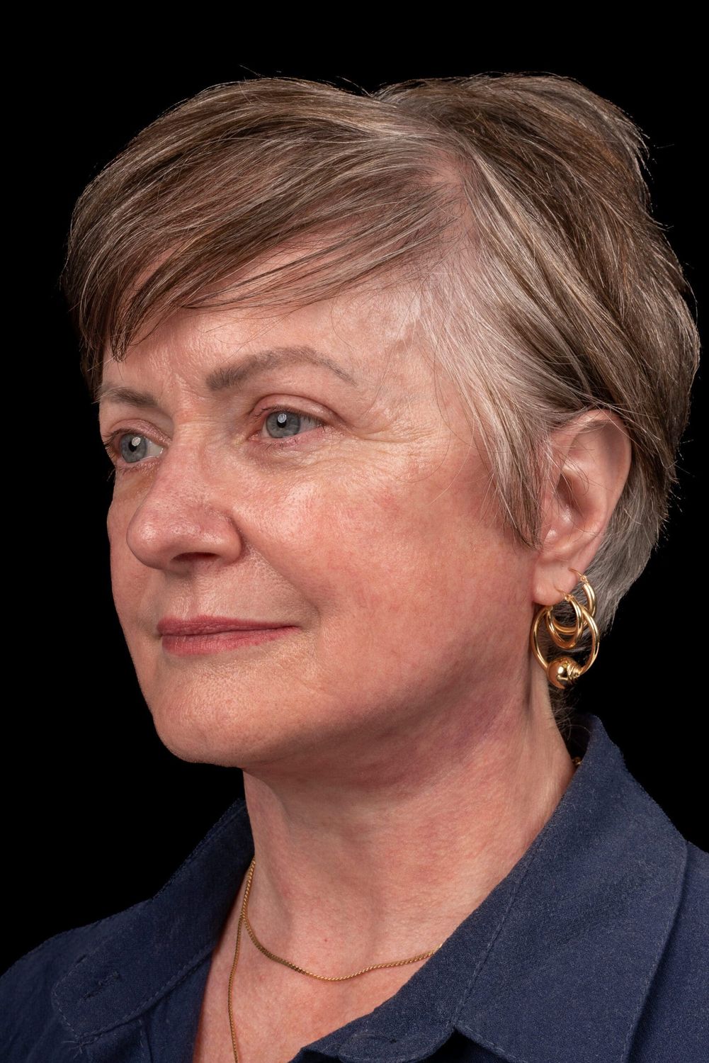 Facelift Before & After