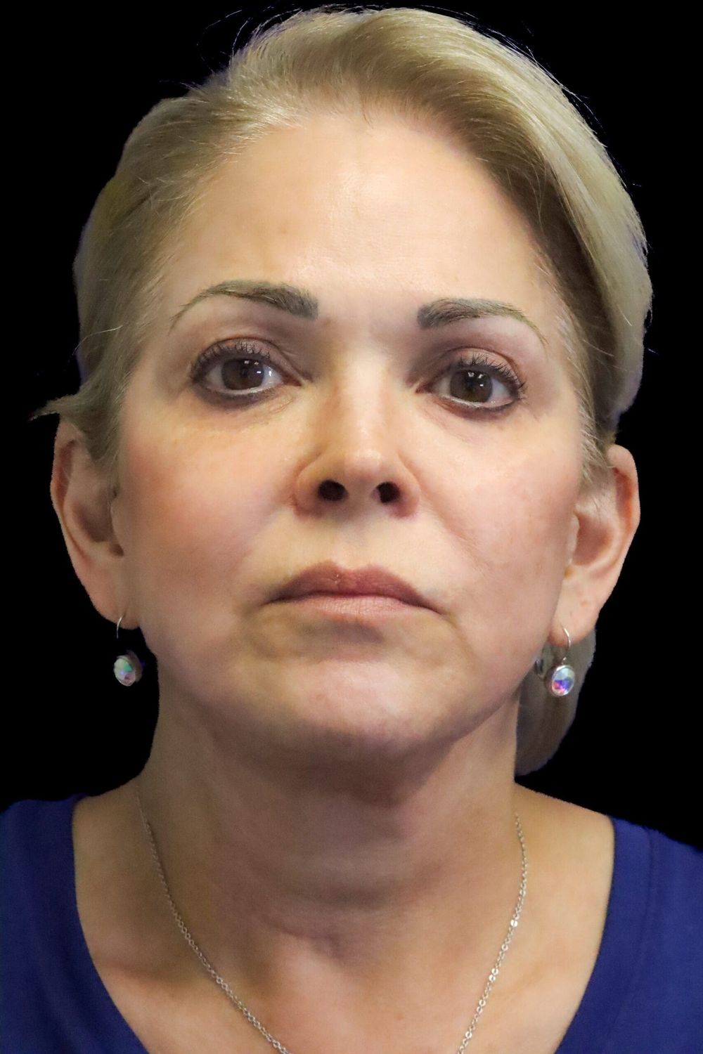Facelift Before & After