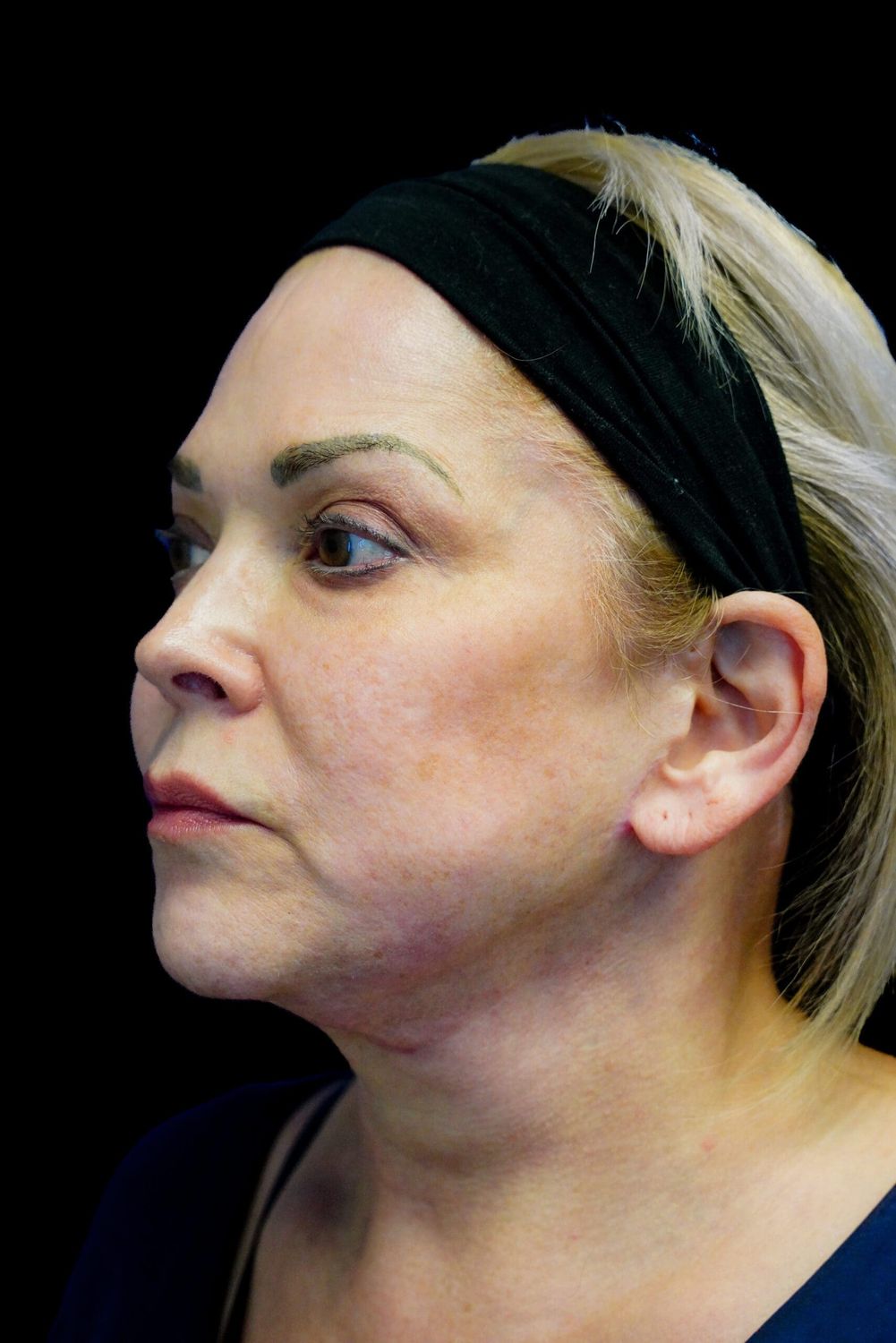 Facelift Before & After