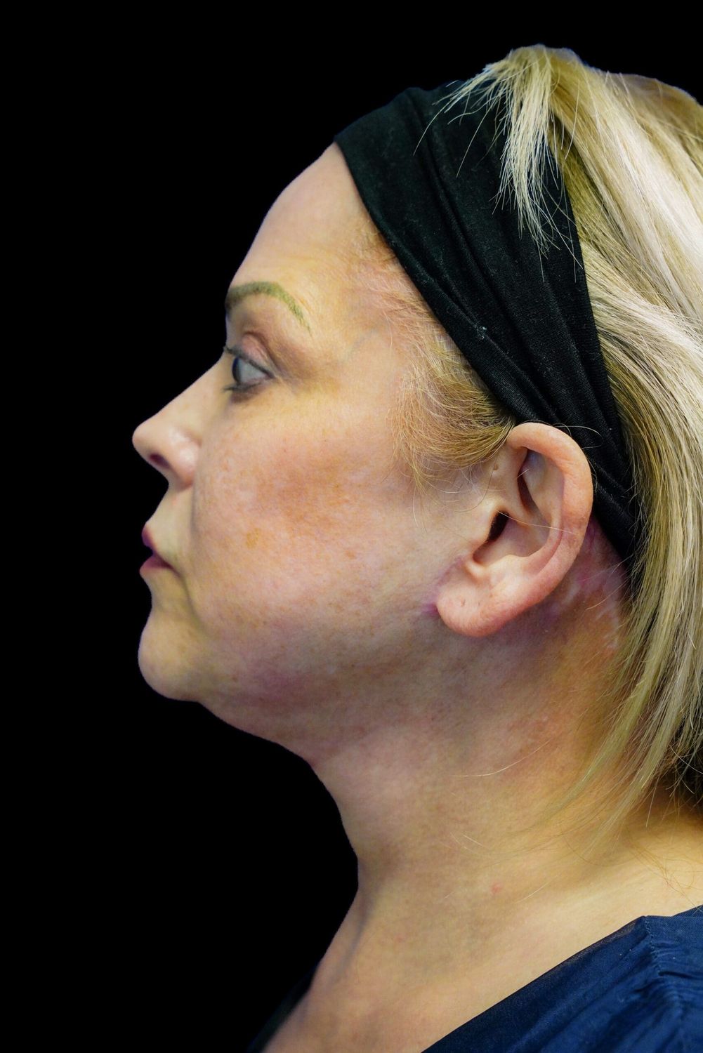 Facelift Before & After