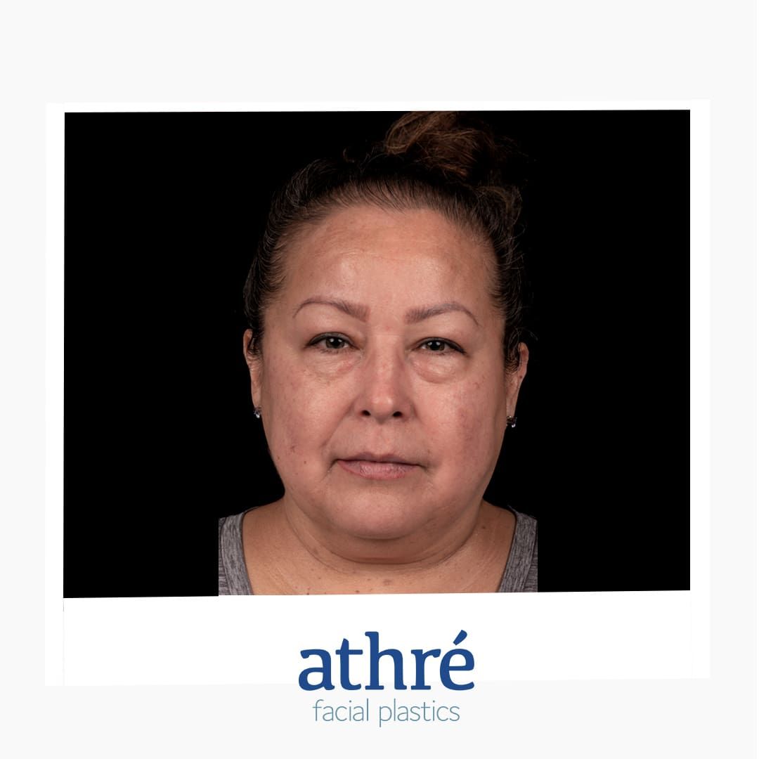 Facelift Before & After