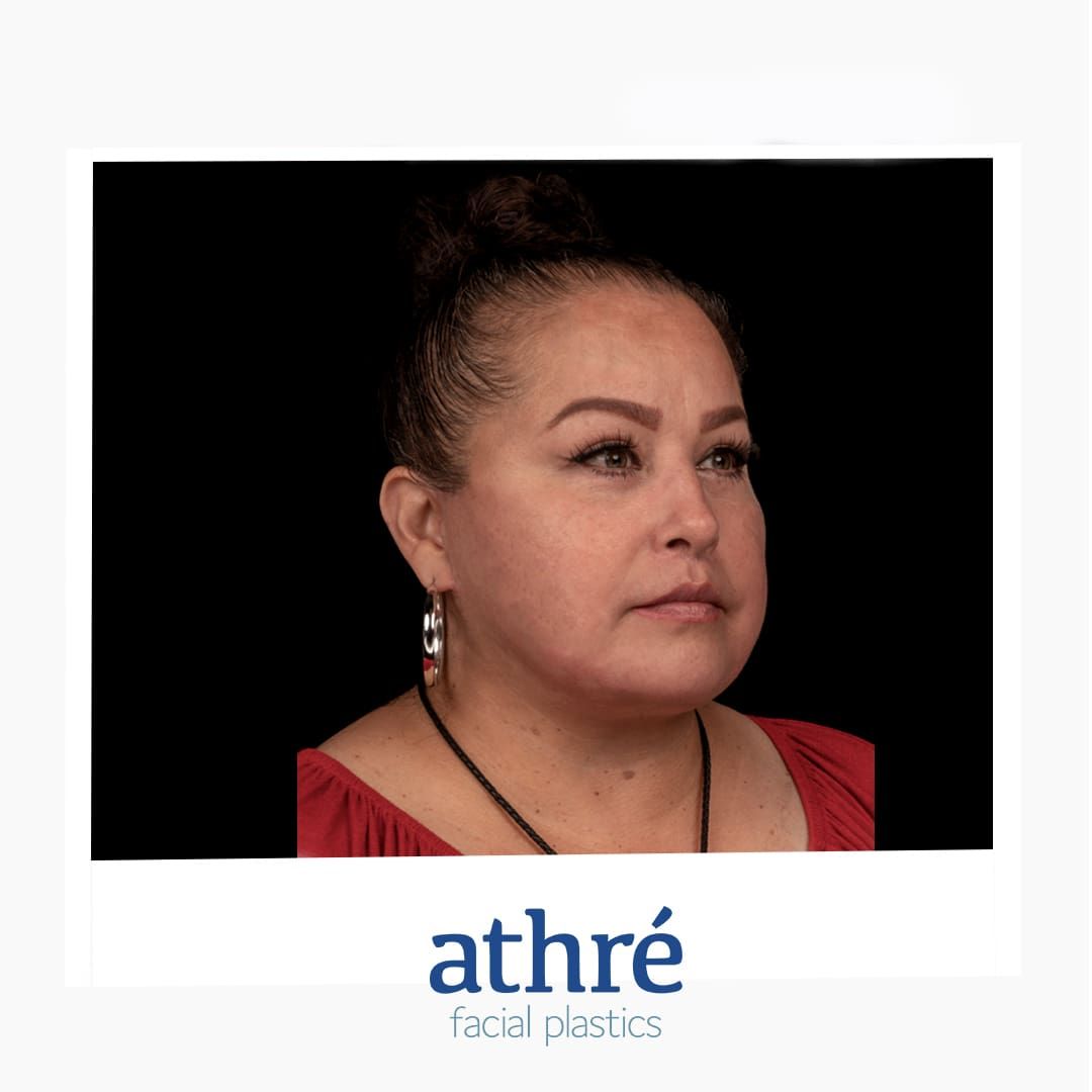 Facelift Before & After