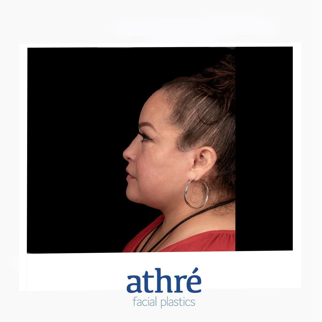 Facelift Before & After